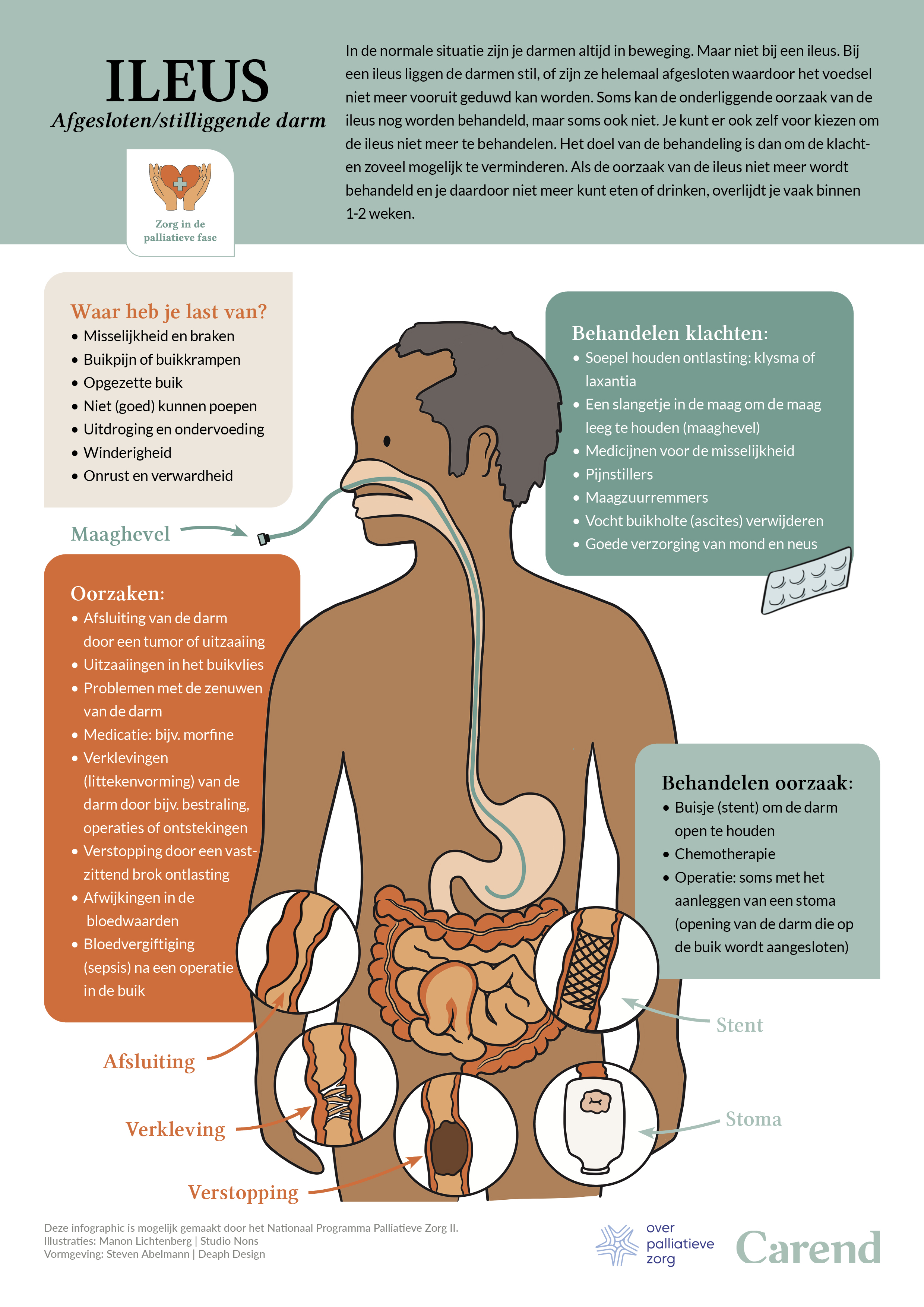  infographic Ileus